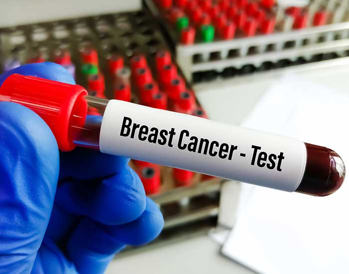 breast cancer test